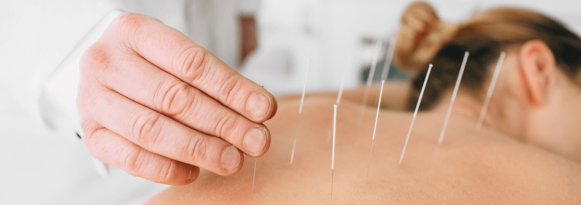 Acupuncture
