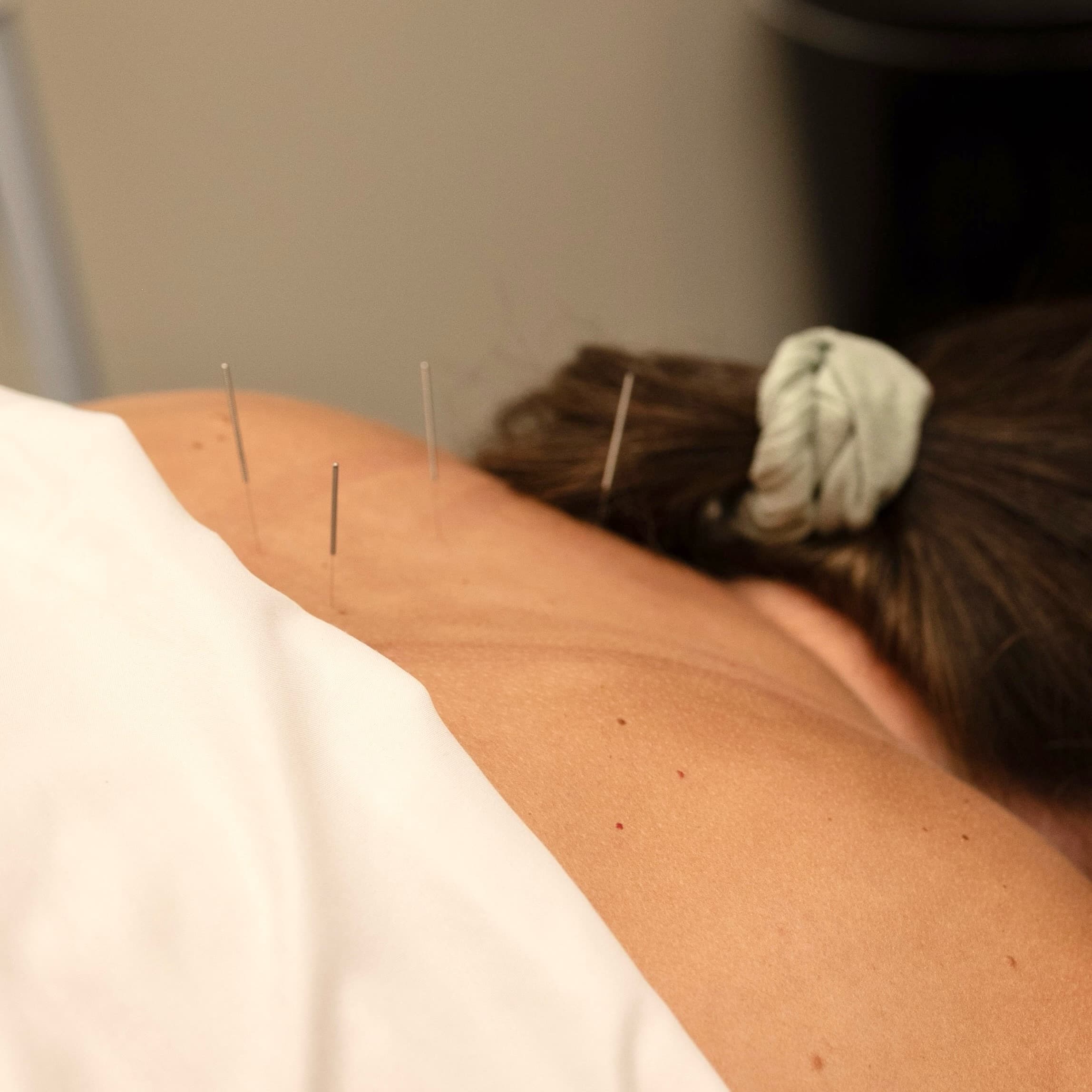 Acupuncture