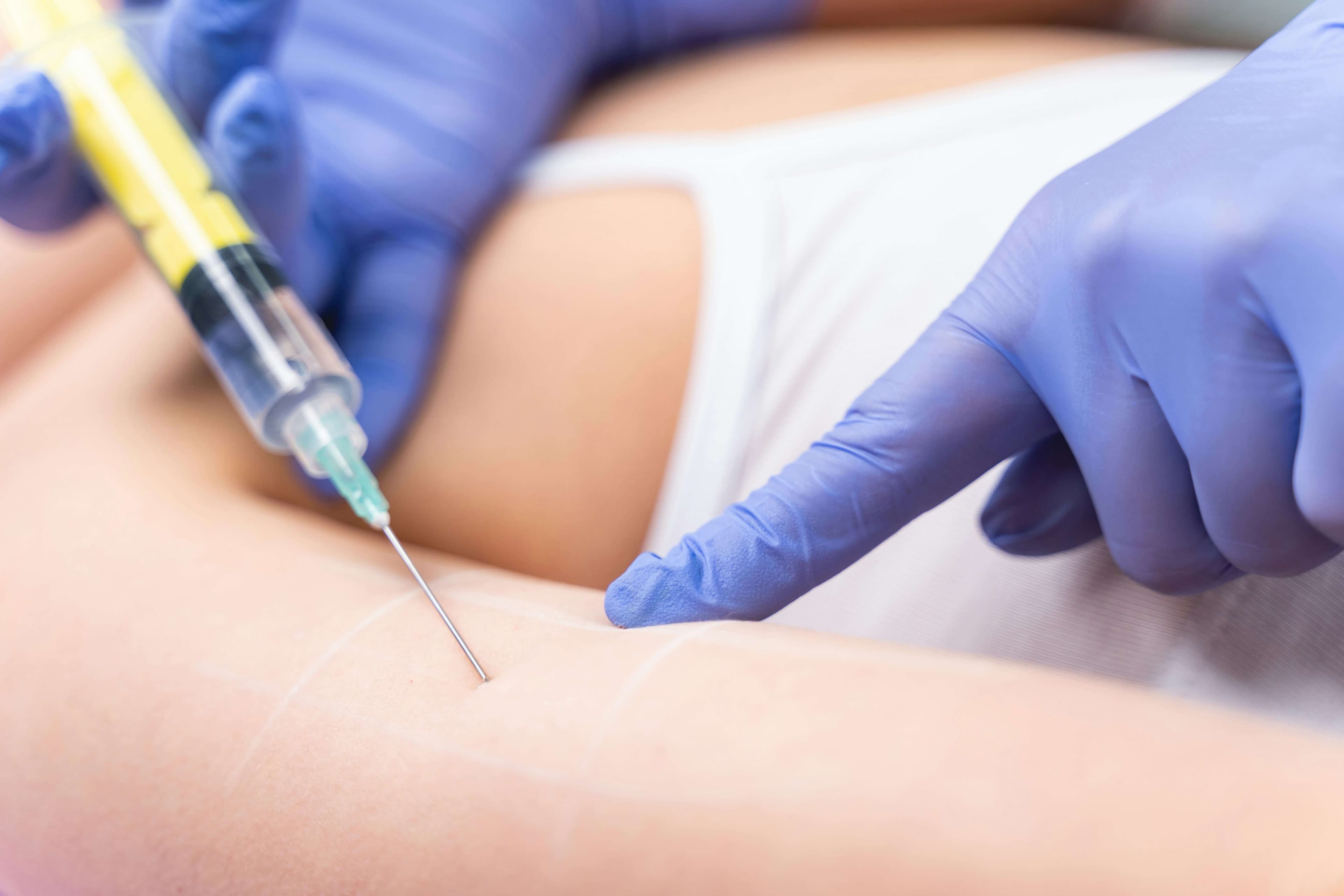 PRP and nSTRIDE APS Therapy