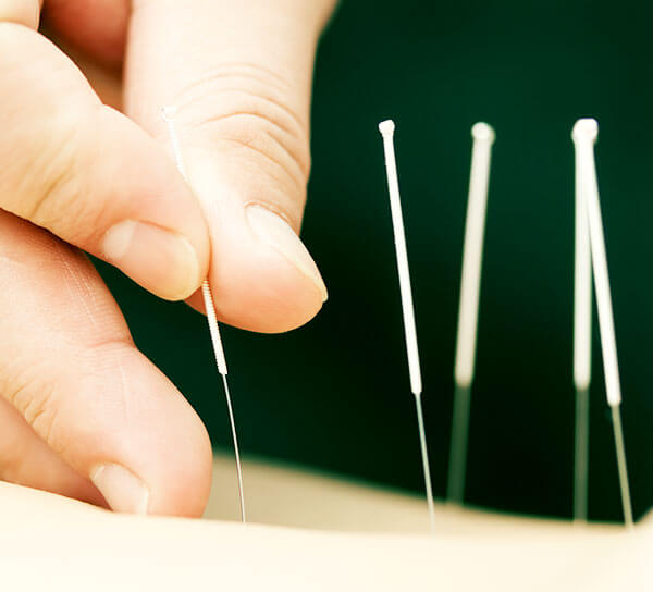 Acupuncture